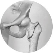 fracture-controlaterale-hanche