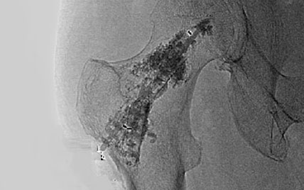 ystrut-indication-oncologie