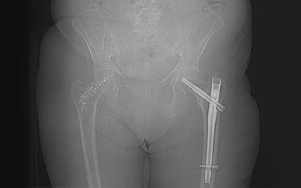 ystrut-indication-traumatologie